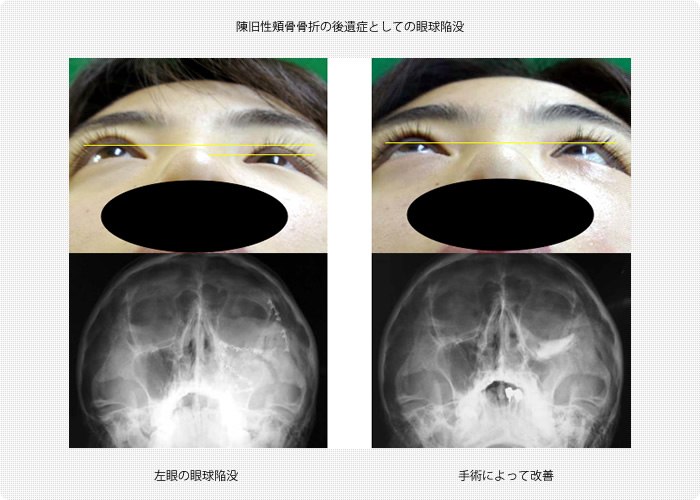 陳旧性頬骨骨折の後遺症としての眼球陥没に伴う眼球運動障害（眼症状とＣＴ所見）
