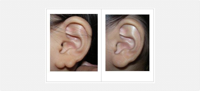 耳垂裂の治療