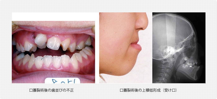 口蓋裂に伴う歯並びの不正、上顎の低形成(受け口)